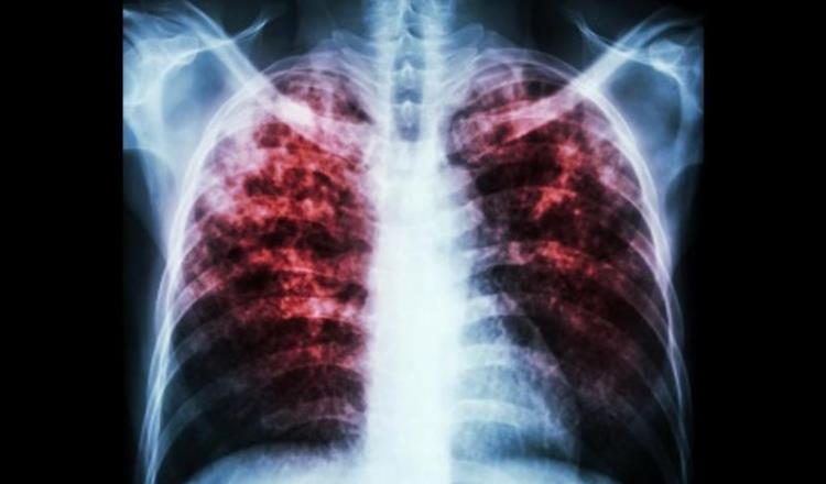 Alerta SSa sobre incremento de tuberculosis en Tabasco 