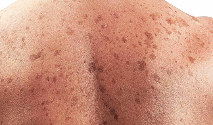Llama Salud a evitar exposición prolongada al sol para prevenir cáncer de piel