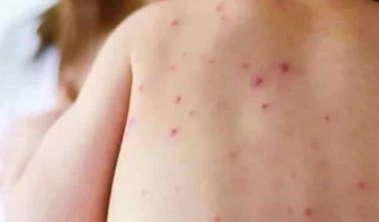 Detectan a niña de 8 años con sarampión en la CDMX