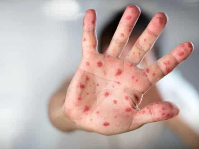 Suman CDMX y Edomex 81 casos de sarampión
