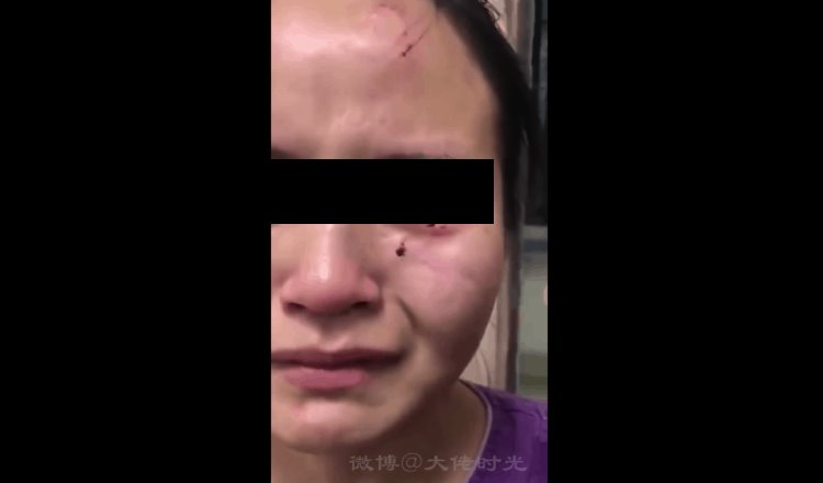 Paciente con Covid-19 golpea y muerde en la cara a enfermera en China