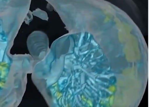 Video 3D del Hospital de la Universidad George Washington revela cómo ataca el Covid-19 a los pulmones