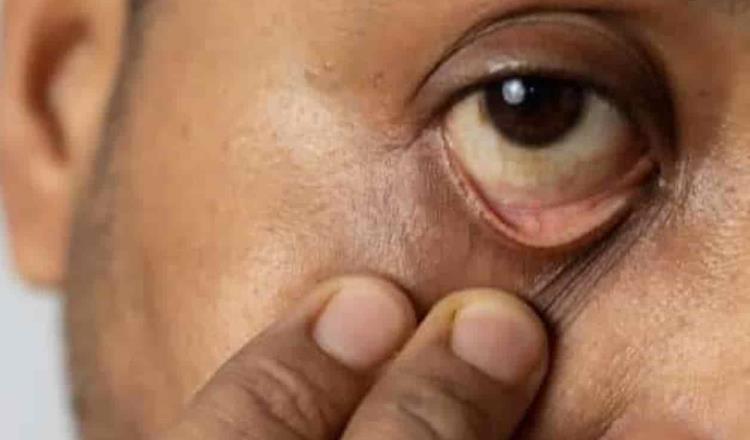 Por hongo negro se presentan casos de ceguera en la India