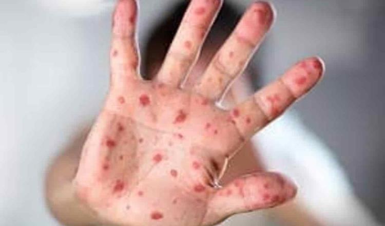 Advierte la OMS que se podrían perder muchas vidas por brote de sarampión en Afganistán