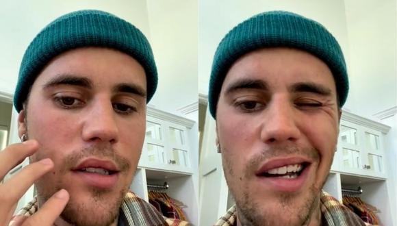 Justin Bieber tiene la mitad del rostro paralizado