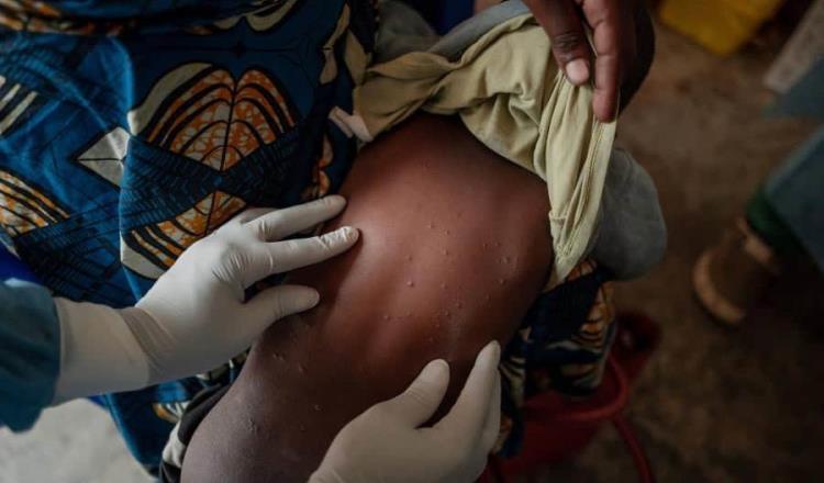 OMS autoriza primera vacuna contra Mpox en África